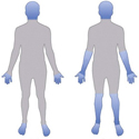 Diffuse cutaneous scleroderma