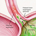 Gastroesophageal reflux