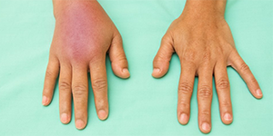 Hand inflammation