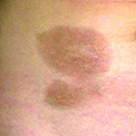 Morphea Scleroderma