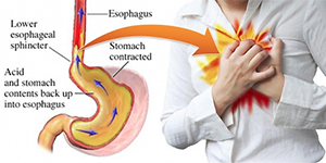 Acid reflux, heartburn