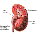 Renal hypertension