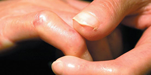 Thinckend skin on the hands