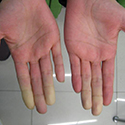 Reduced blood flow in the fingers